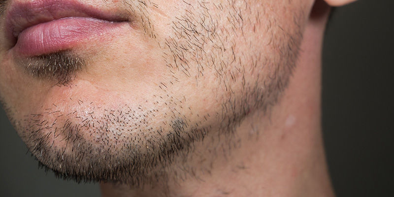 Cannabinoids, testosteronnivåer och hårväxt Cannabinoids, Testosterone Level, And Hair Growth