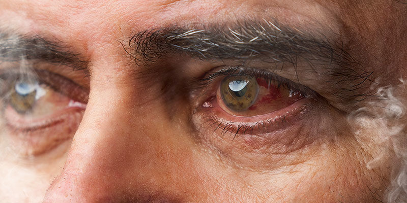 Varför orsakar cannabis röda ögon? Why does cannabis cause red eyes?